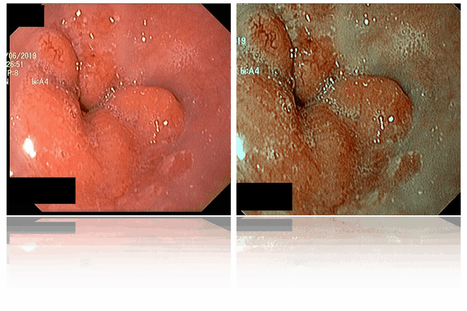 Real time chromatic restoration for improving tissue and vessel discrimination